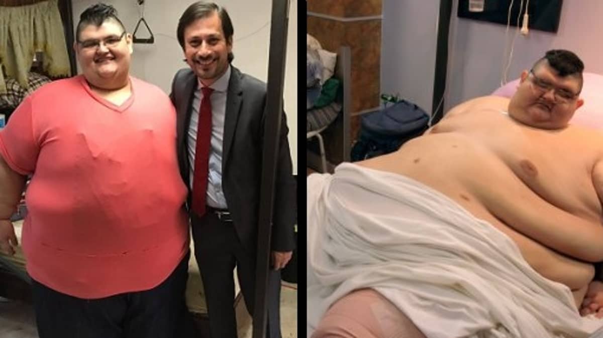 'World's Most Obese Man' Sheds Half His Body Weight After Gastric