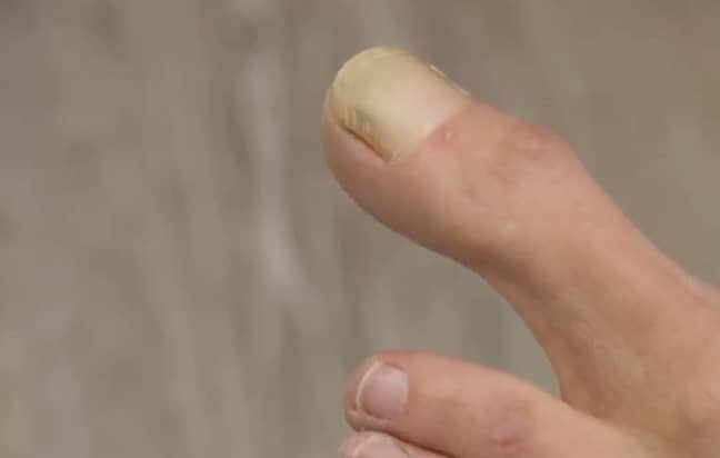 Woman Appears On My Feet Are Killing Me With Extremely Rare Big Toe