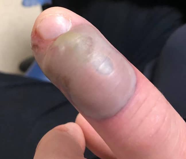 Woman Warns People Not To Bite Nails After Friend Gets Serious Infection Ladbible